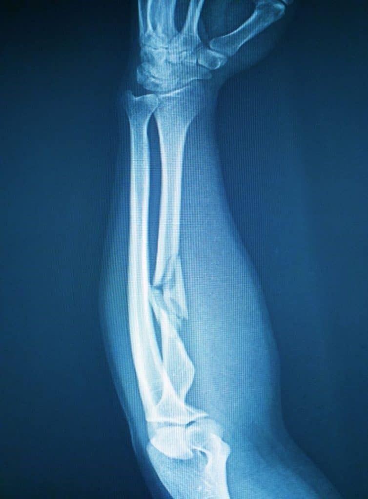 healing from a fracture