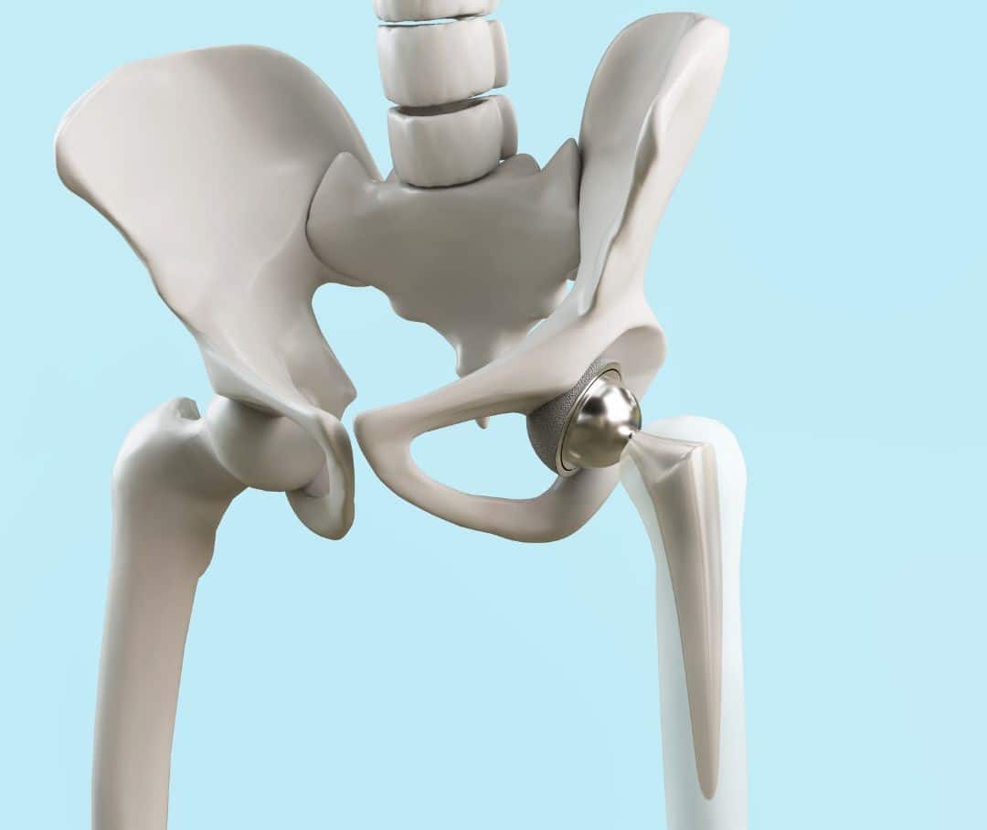 hip repacement