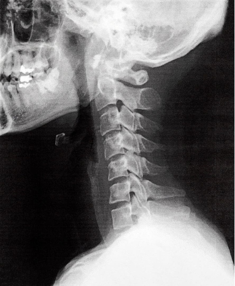 cervical kyphosis