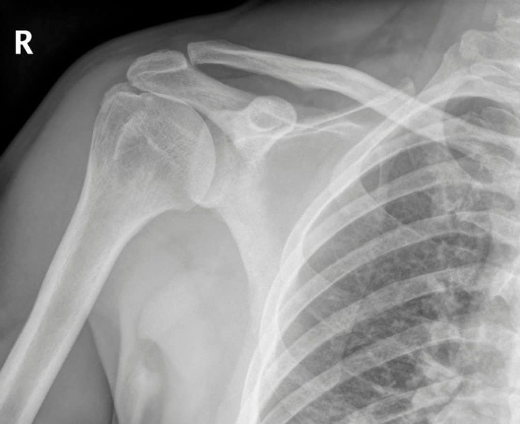 shoulder stability