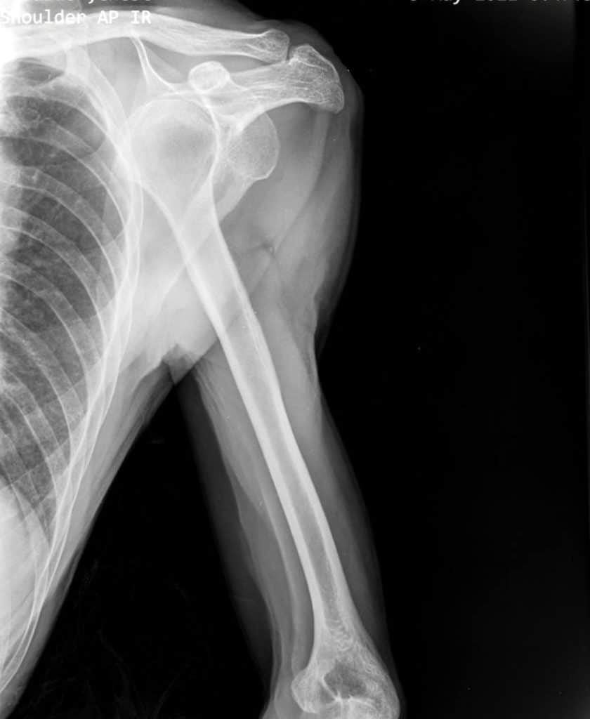shoulder dislocations