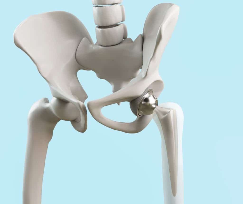 hip repacement