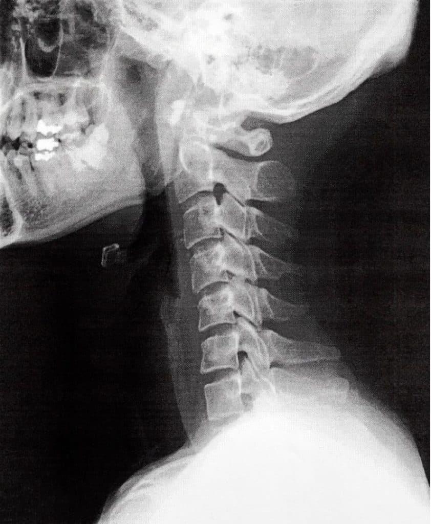 cervical kyphosis