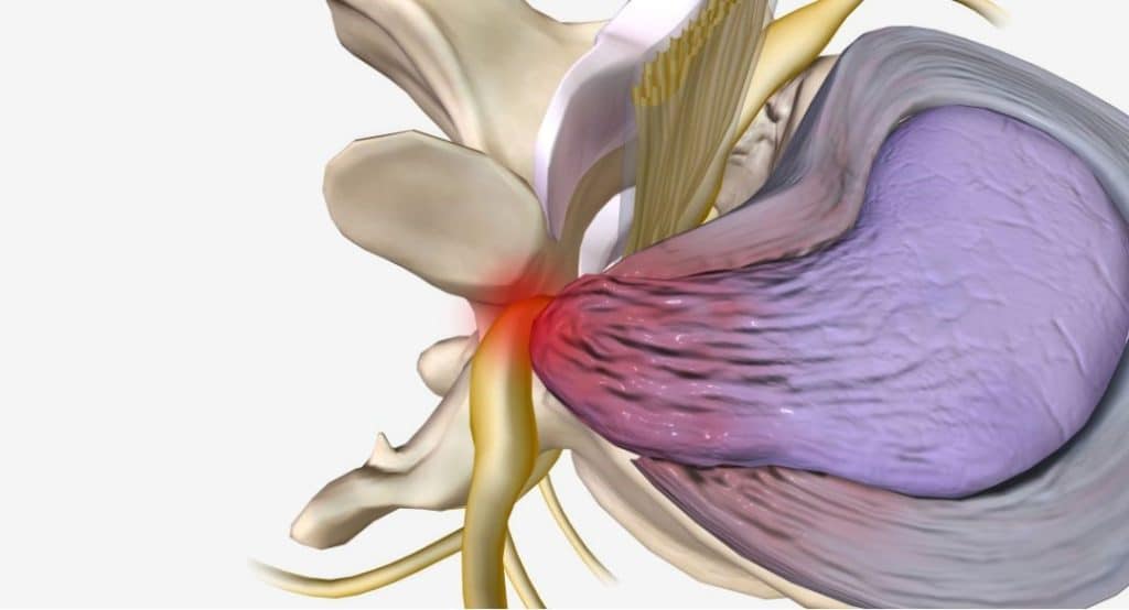 disc injuries