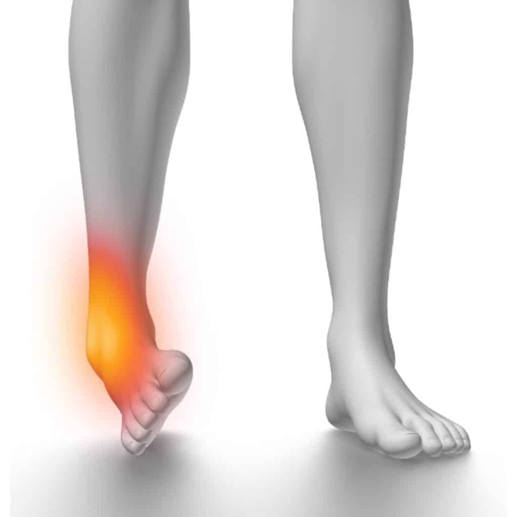 lateral ankle sprain