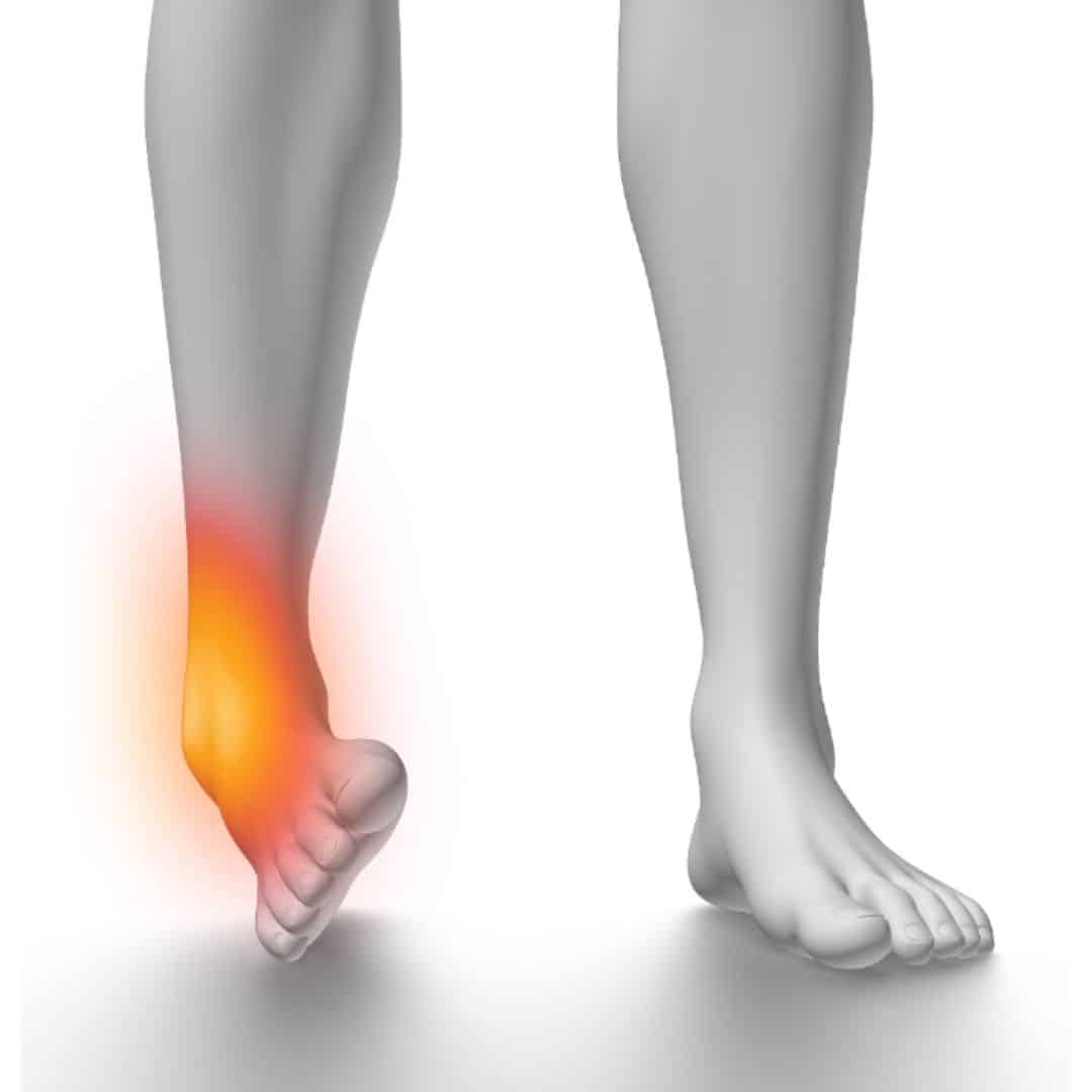 lateral ankle sprain