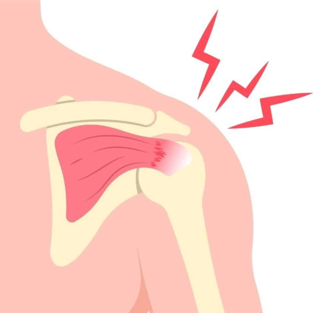 rotator cuff tears