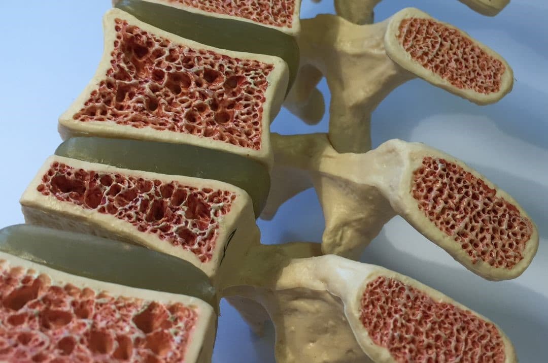 Osteoporosis