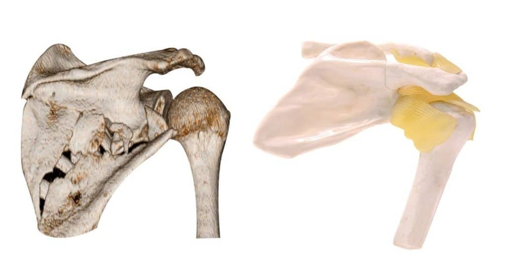 subacromial impingement
